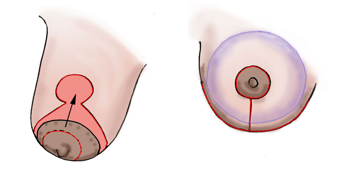 Droopy , low volume breast , showing design of the skin reduction and the result following augmentation mastopexy